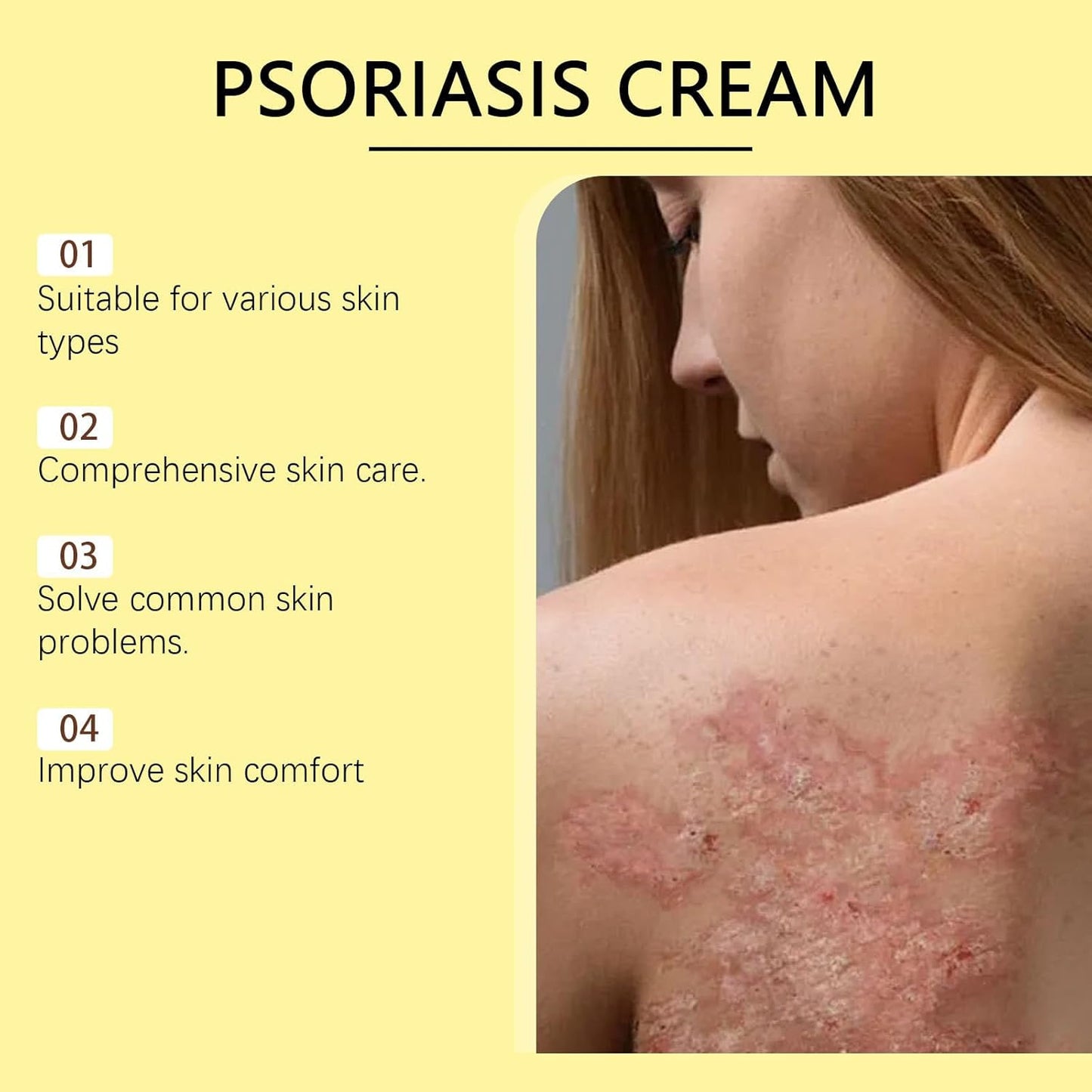 Psoriasis Cream